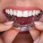 Exploring the Lifespan and Maintenance of Dental Retainers