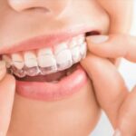 A Guide to Invisible Braces in Dubai