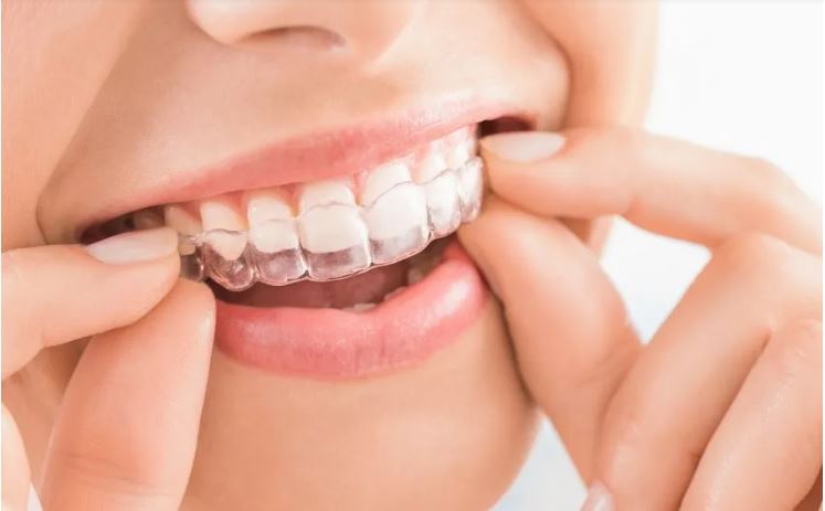 A Guide to Invisible Braces in Dubai