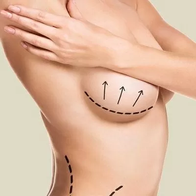 How long do the results of a breast lift last?