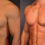 gynecomastia surgery in dubai