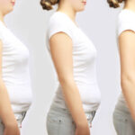 Liposuction surgery in Dubai