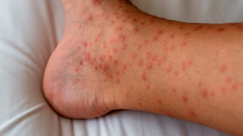 papular dermatitis