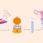 IUI Treatment