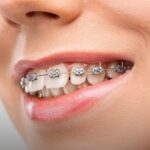 What They Don’t Tell You About Dental tooth Implants with Pros and Cons