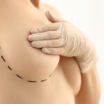 Uncovering the Secrets of Breast Lift