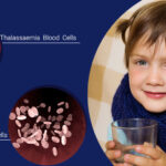 What Are the Best Treatment Options for Thalassemia in India