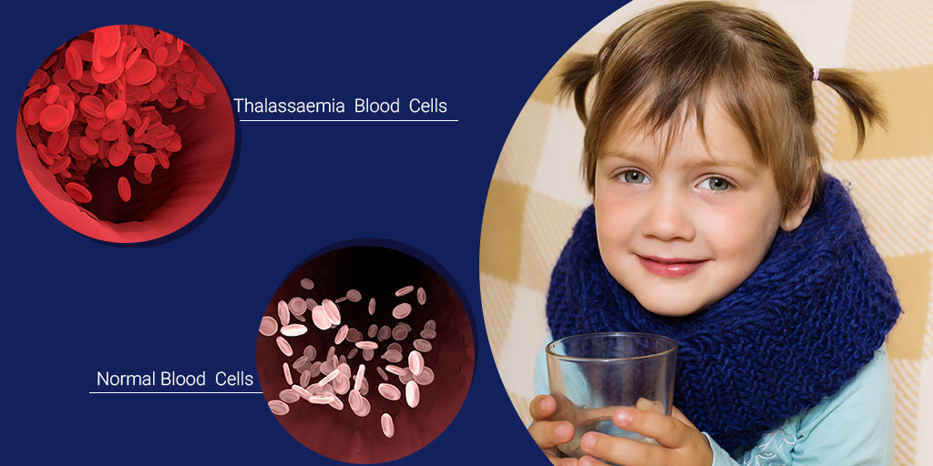 What Are the Best Treatment Options for Thalassemia in India