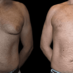 Combining Gynecomastia with Male Facelifts: A Holistic Approach in Dubai