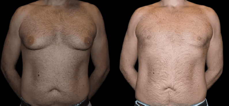 Combining Gynecomastia with Male Facelifts: A Holistic Approach in Dubai