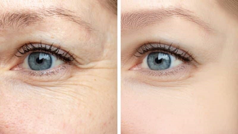 skin fine line treatment Southampton