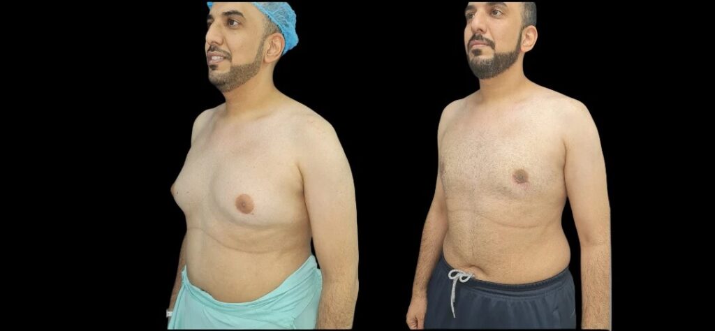 Preparing for a Smooth Journey: Insights from the Best Doctors in Dubai for Gynecomastia Surgery