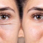 brow lift san diego