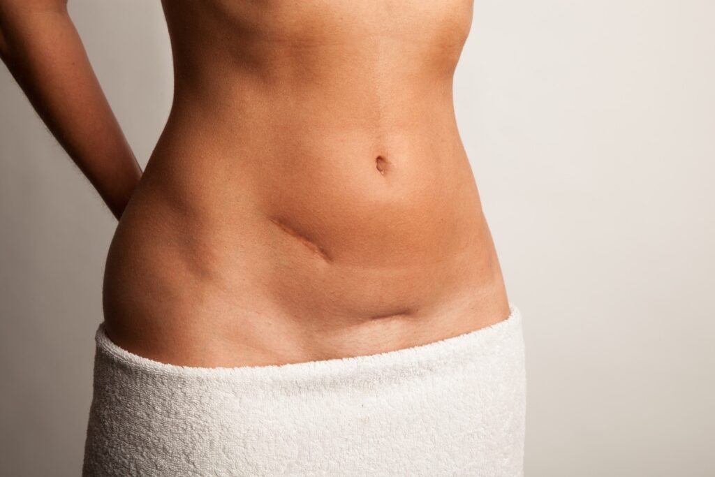 tummy tuck in NYC