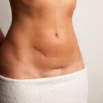 tummy tuck in NYC