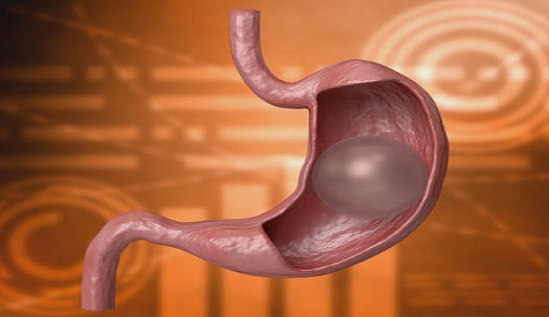 Gastric Balloon Surgery in Riyadh