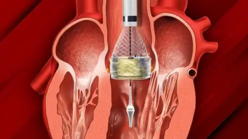 TAVR Treatment in India