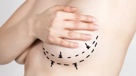 Restore Confidence With a Breast Lift in Chicago