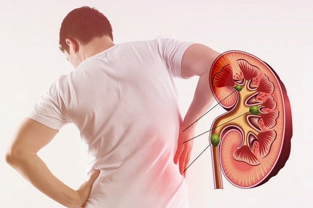 Kidney Stone Treatment in Jaipur